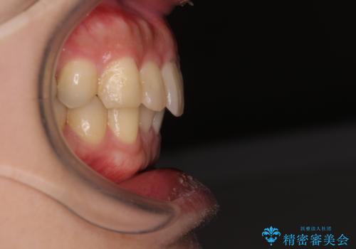 深い咬み合わせで顎が疲れる ワイヤー矯正でディープバイトを解消の治療後