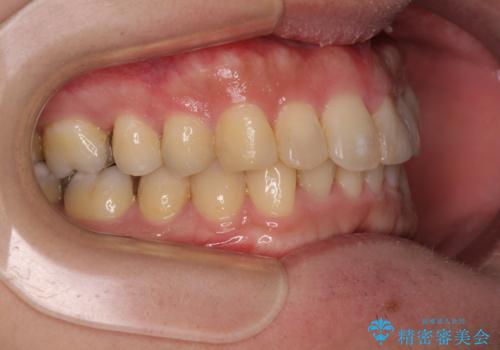深い咬み合わせで顎が疲れる ワイヤー矯正でディープバイトを解消の治療後