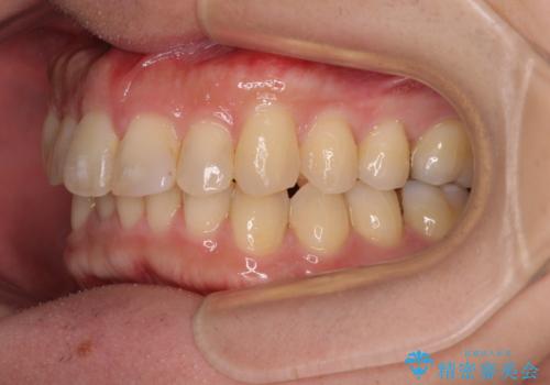 深い咬み合わせで顎が疲れる ワイヤー矯正でディープバイトを解消の治療後