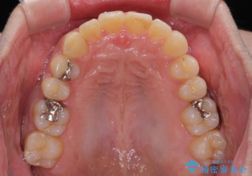 深い咬み合わせで顎が疲れる ワイヤー矯正でディープバイトを解消の治療後