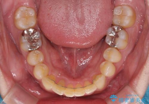 深い咬み合わせで顎が疲れる ワイヤー矯正でディープバイトを解消の治療後