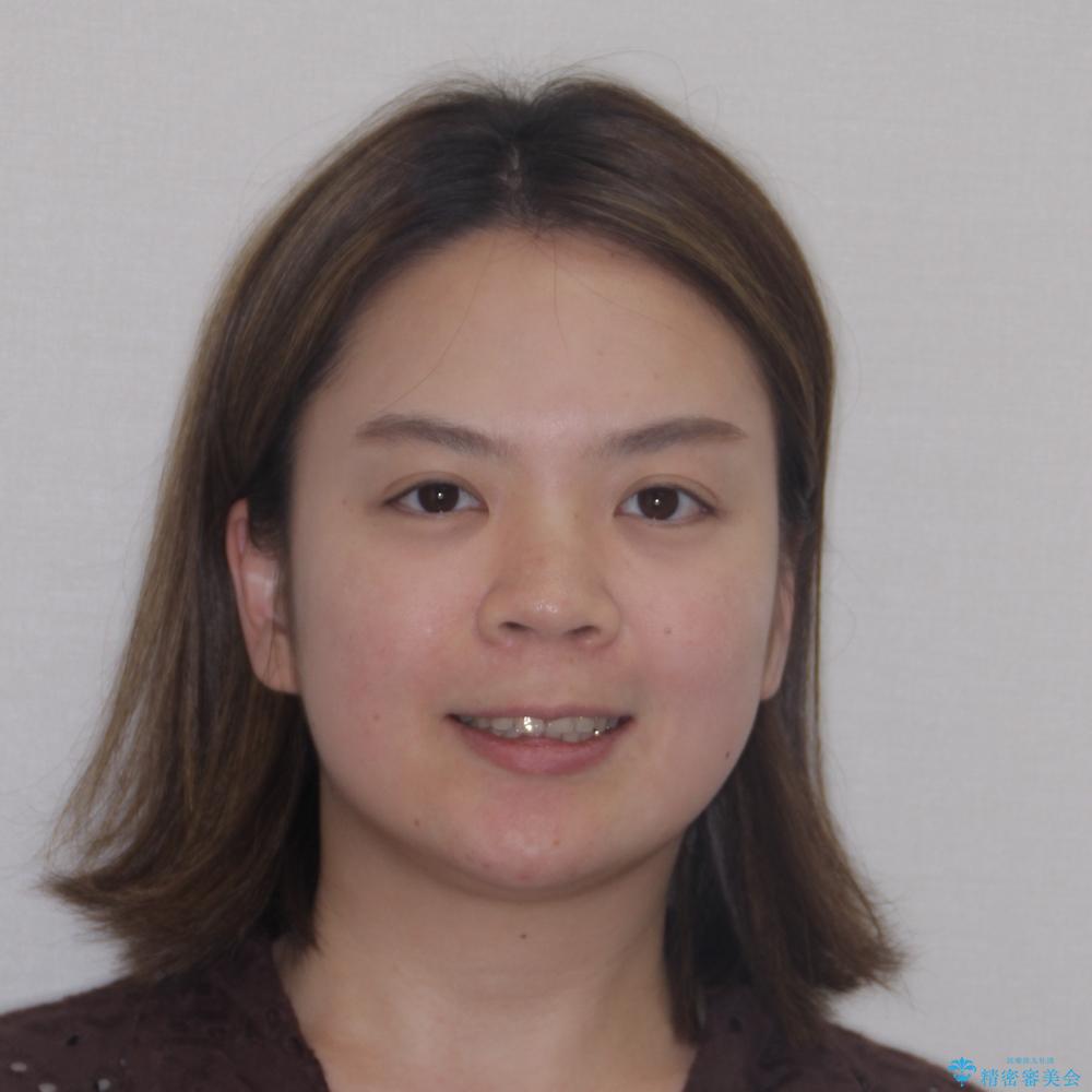 【モニター】上下の八重歯を治したい ワイヤー装置による矯正治療の治療後(顔貌)