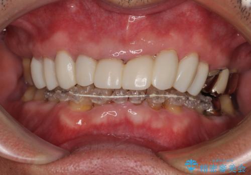 変色した前歯をきれいにしたい 部分矯正を併用した前歯の審美歯科治療の治療中