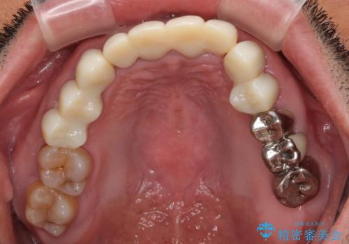 変色した前歯をきれいにしたい　部分矯正を併用した前歯の審美歯科治療の治療中