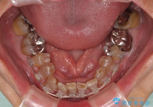 変色した前歯をきれいにしたい 部分矯正を併用した前歯の審美歯科治療の治療中