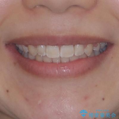 前歯のガタガタを整えたい　ワイヤー装置による抜歯矯正治療の治療後（顔貌）