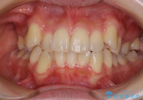デコボコで磨きにくい歯列　ワイヤー装置での抜歯矯正で歯磨きをしやすくの症例 治療前