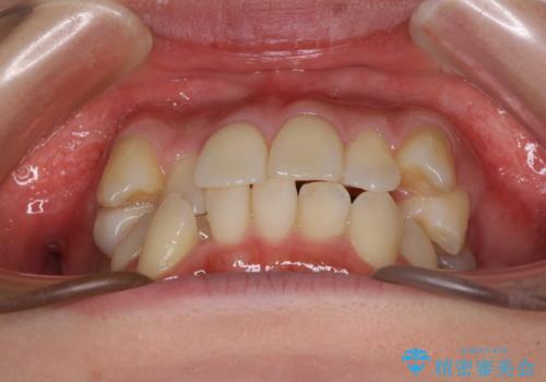 デコボコで磨きにくい歯列 ワイヤー装置での抜歯矯正で歯磨きをしやすくの治療前