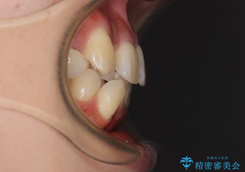 デコボコで磨きにくい歯列 ワイヤー装置での抜歯矯正で歯磨きをしやすくの治療前