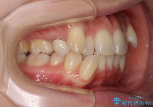 デコボコで磨きにくい歯列 ワイヤー装置での抜歯矯正で歯磨きをしやすくの治療前