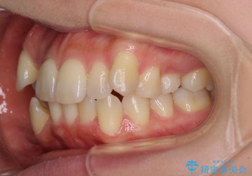 デコボコで磨きにくい歯列 ワイヤー装置での抜歯矯正で歯磨きをしやすくの治療前