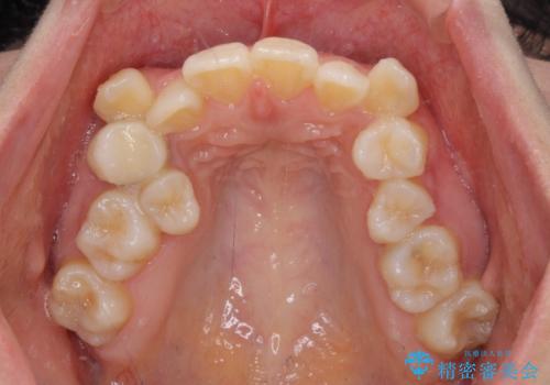 デコボコで磨きにくい歯列　ワイヤー装置での抜歯矯正で歯磨きをしやすくの治療前