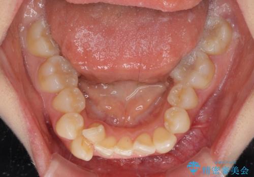 デコボコで磨きにくい歯列　ワイヤー装置での抜歯矯正で歯磨きをしやすくの治療前