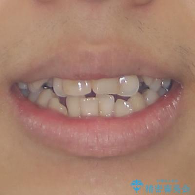 八重歯と開咬　ワイヤー装置での抜歯矯正の治療前（顔貌）