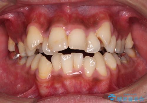 八重歯と開咬　ワイヤー装置での抜歯矯正の症例 治療前