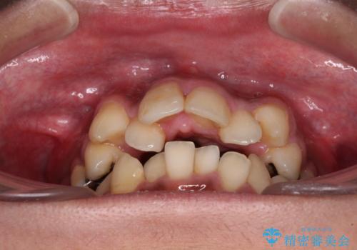 八重歯と開咬 ワイヤー装置での抜歯矯正の治療前