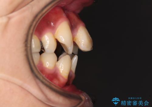 八重歯と開咬　ワイヤー装置での抜歯矯正の治療前