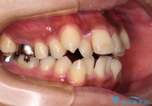 八重歯と開咬 ワイヤー装置での抜歯矯正の治療前