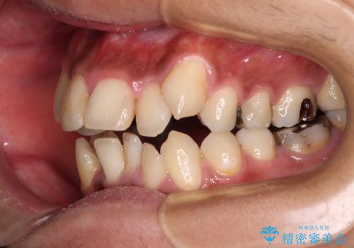 八重歯と開咬 ワイヤー装置での抜歯矯正の治療前