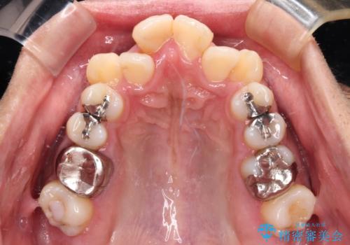 八重歯と開咬 ワイヤー装置での抜歯矯正の治療前