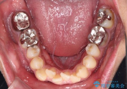 八重歯と開咬 ワイヤー装置での抜歯矯正の治療前