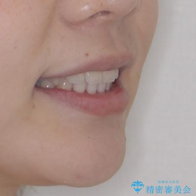 くちばしのような前歯が気になる　ワイヤー装置による抜歯矯正治療の治療後（顔貌）