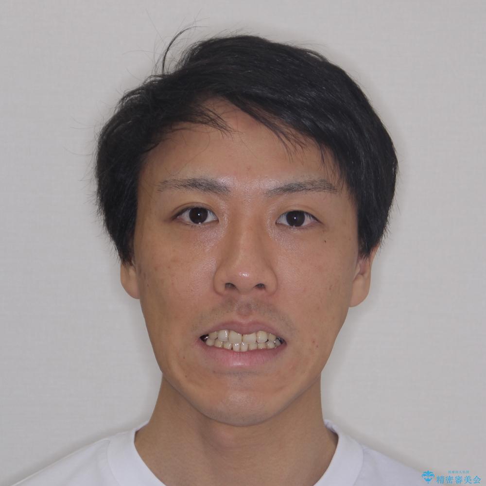 【モニター】舌のトレーニングを行いながら後戻りの再矯正の治療後(顔貌)