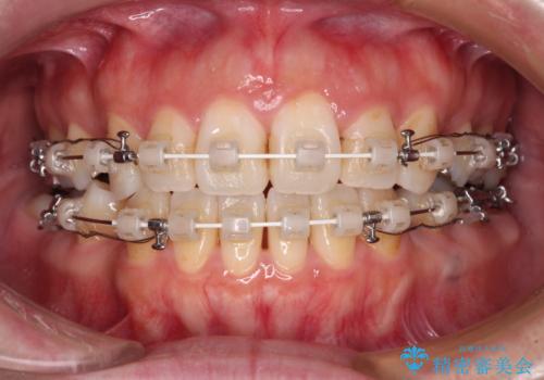出っ歯と奥歯の欠損 ワイヤー矯正とインプラント治療の治療中