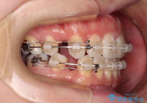 出っ歯と奥歯の欠損 ワイヤー矯正とインプラント治療の治療中