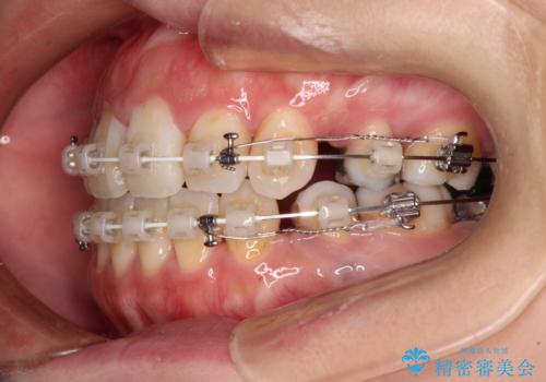 出っ歯と奥歯の欠損　ワイヤー矯正とインプラント治療の治療中