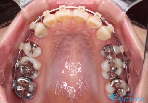 出っ歯と奥歯の欠損 ワイヤー矯正とインプラント治療の治療中