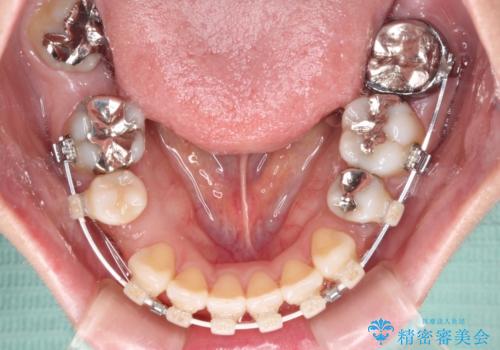 出っ歯と奥歯の欠損　ワイヤー矯正とインプラント治療の治療中