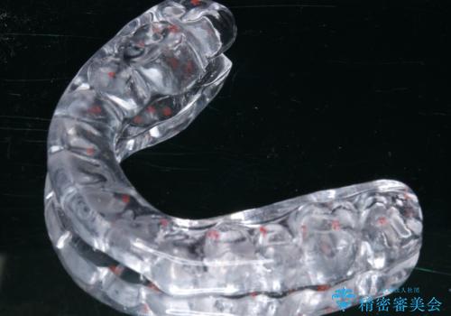 ナイトガードで就寝時の歯の予防の治療中