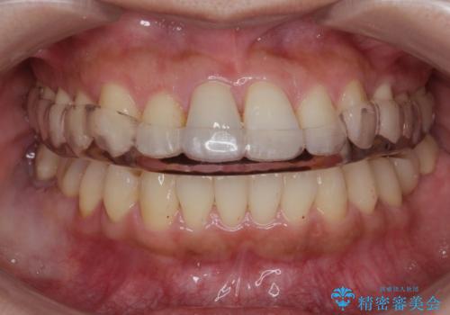 ナイトガードで就寝時の歯の予防の症例 治療後
