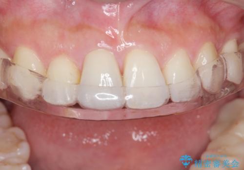 ナイトガードで就寝時の歯の予防の治療中