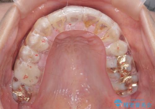 ナイトガードで就寝時の歯の予防の治療後