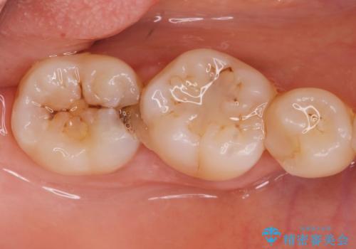 歯に食べ物が詰まる。の治療前