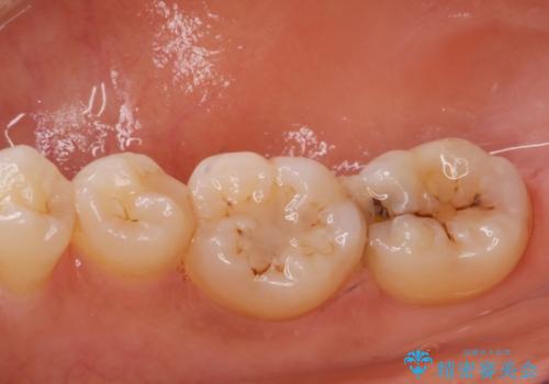 歯に食べ物が詰まる。の治療前