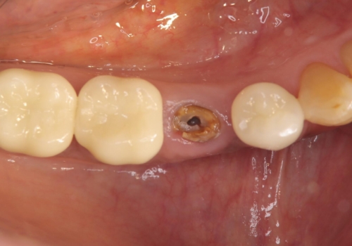 被せ物がとれた オールセラミックによるブリッジ治療の治療前