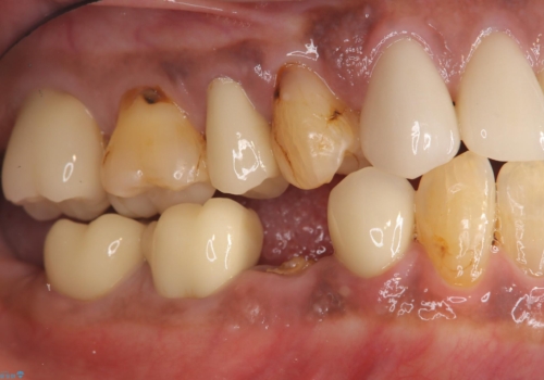 被せ物がとれた オールセラミックによるブリッジ治療の症例 治療前