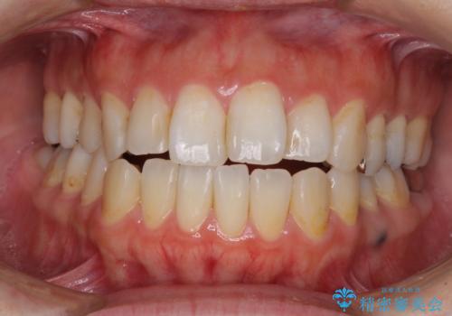 出っ歯と奥歯の欠損　ワイヤー矯正とインプラント治療の症例 治療前