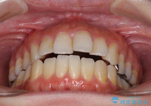 出っ歯と奥歯の欠損　ワイヤー矯正とインプラント治療の治療前