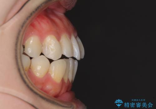 出っ歯と奥歯の欠損　ワイヤー矯正とインプラント治療の治療前