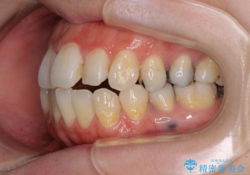 出っ歯と奥歯の欠損 ワイヤー矯正とインプラント治療の治療前
