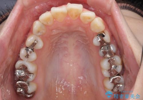 出っ歯と奥歯の欠損 ワイヤー矯正とインプラント治療の治療前