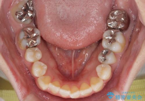 出っ歯と奥歯の欠損 ワイヤー矯正とインプラント治療の治療前