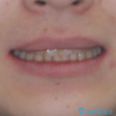 深い咬み合わせで顎が疲れる ワイヤー矯正でディープバイトを解消の治療後(顔貌)