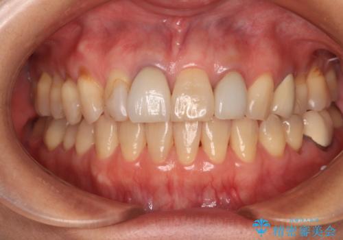 モザイク模様の前歯 オールセラミッククラウンで整った印象にの治療前