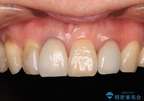 モザイク模様の前歯 オールセラミッククラウンで整った印象にの症例 治療前