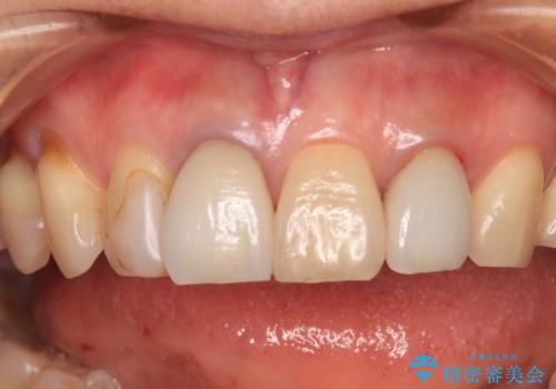 モザイク模様の前歯 オールセラミッククラウンで整った印象にの治療前